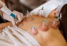 Cupping Therapy